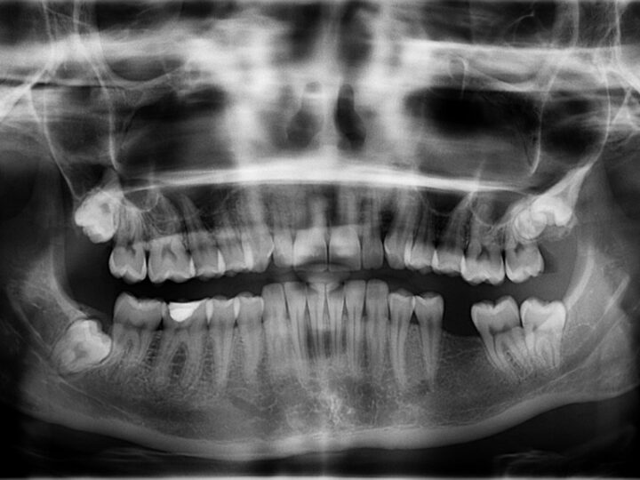 Sonhar com dente caindo da boca: 5 interpretações que revelam inseguranças