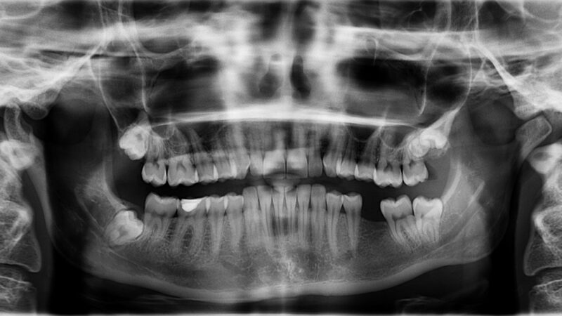 Sonhar com dente caindo da boca: 5 interpretações que revelam inseguranças