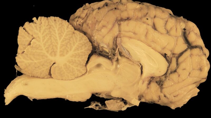 Lado direito do cérebro: funções e importância